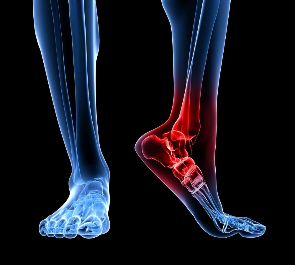7248682 - skeletal foot with highlighted ankle